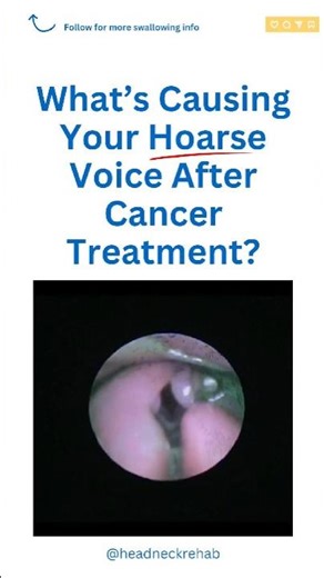 What’s Causing Your Hoarse Voice After Cancer Treatment?