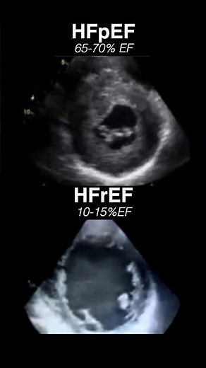 Echocardiogram HFpEF vs HFrEF #radiology #cardiology