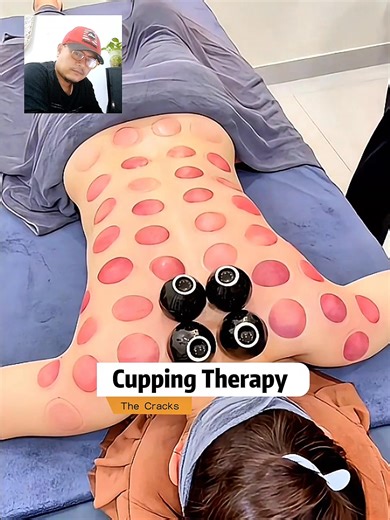 Cupping therapy originates from China and is still used today for various treatments. #Cuppingtherapy #cuppingmassage #massage #Bekam | The Cracks