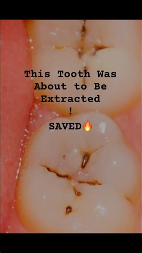 One Mistake That Causes Cavities 😱|Don’t Ignore Tooth Pain😱Before&After Tooth Restoration