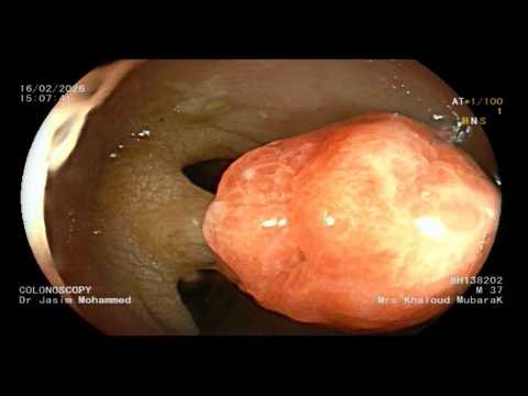 The endoscopic battle: Adenoma Vs Juvenile polyp. unveiling the true pit pattern
