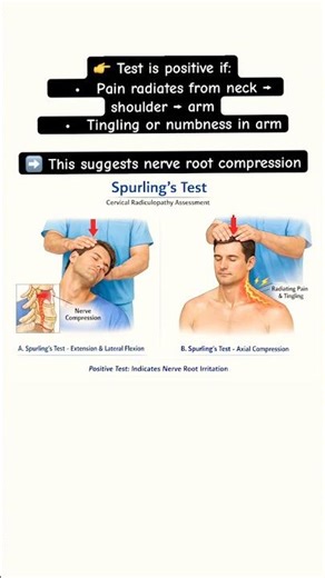 Nerve root compression test#viral #awareness #physiotherapy #medical #trending #cervical #pain