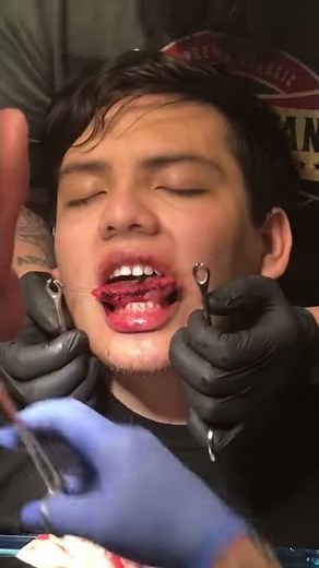 Tongue split suturing