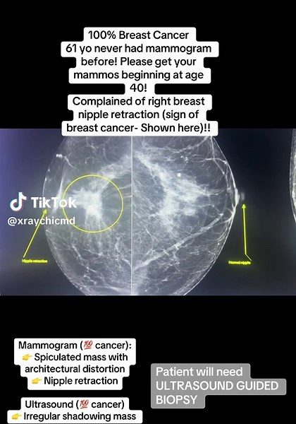 Understanding Breast Cancer Detection Techniques
