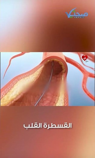 أبرز المعلومات عن قسطرة القلب