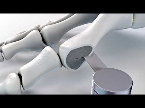 Hallux valgus correction (Chevron, Scarf) with MAGNEZIX® CS 2.7 [EN]