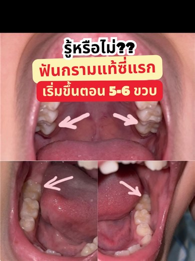 ฟันกรามแท้ซี่แรก ขึ้นตอนไหน?? คุณพ่อคุณแม่ต้องสังเกตดูที่ฟันหลังด้วยนะคะ เพราะจะมีฟันกรามแท้ขึ้นต่อจากฟันน้ำนมซี่สุดท้ายเข้าไป ตอนอายุ 5-6 ขวบ จะได้ไม่พลาดการแปรงฟันให้ถึงฟันแท้ค่ะ #คลินิกลาแปง #หมอจิ๊บจ๊อย #ฟันแท้ซี่แรก #ตรวจฟันเด็ก #ฟันกรามซี่แรก