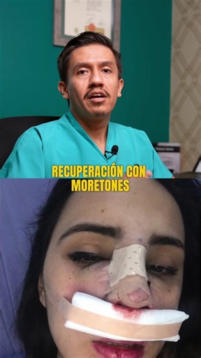 Rinoplastia: Recuperación y Mitos sobre Moretones