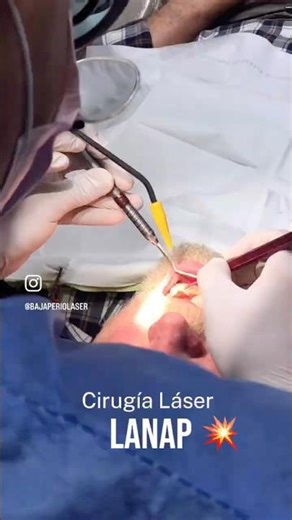 LANAP dental laser procedure #LANAP #gumdisease #periodontics #dentalcare