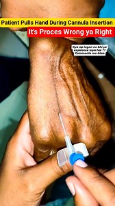 163K views · 768 reactions | IV Cannula Insertion #doctor #bestmedicalcollegeinindia #medicalequipment #hospital #ivcannula #reelsvideoシ #shortsreels #reelsfypシ #fbreelsfypシ゚ #trendingreel #fbshorts #nursing #viral #nursingstudent #cannulation | Medical Info Tips | Facebook