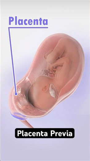 How placenta can block your baby's birth (3D Animation)