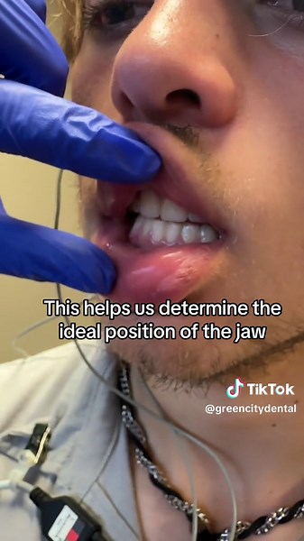 We use TENS to relax the jaw muscles and help us determine the ideal jaw relationship/bite when making a splint, orthotic, or nightguard. #biologicaldentist #dentistry #greencitydental #oralhealth #holistichealth #holisticdentistry #dentaltiktok #holisticdentist #neuromusculardentistry #neuromusculardentist #TENS #tmj #tmjdisorder -#tmjtreatment #tmjd #jawpain #jawpainrelief #neckpain #nightguard #airwayhealth #airwaydentistry #o2dontics #dentalguard