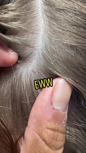 Identifying Lice on the Scalp