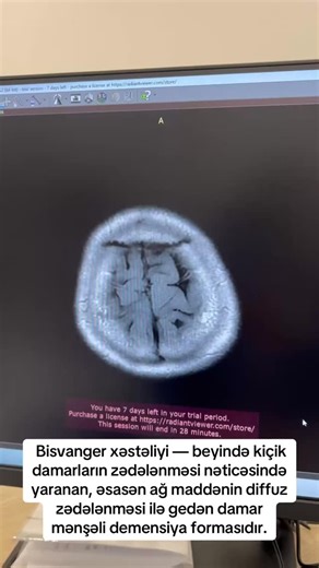 Nevroloq Sevinc Mir Seyid on Instagram: "Bisvanger xəstəliyi (Binswanger disease) — beyində kiçik damarların zədələnməsi nəticəsində yaranan, əsasən ağ maddənin (white matter) diffuz zədələnməsi ilə gedən damar mənşəli demensiya formasıdır. ⸻ ✅ Əsas səbəb nədir? Bu xəstəlikdə beyindəki kiçik arteriyalar qalınlaşır və qan axını azalır → beyində xroniki işemiya yaranır → ağ maddə tədricən zədələnir. ⸻ ✅ Risk faktorları Ən çox aşağıdakı hallarda görülür: • Uzunmüddətli arterial hipertenziya • Diabe