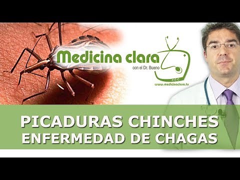 Bedbug bites and Chagas disease | How to treat bedbug bites