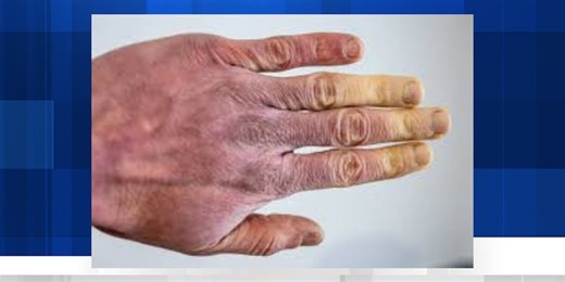 How to protect yourself from frostbite