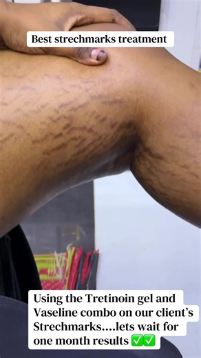 Best Stretch Marks Treatment with Tretinoin Gel