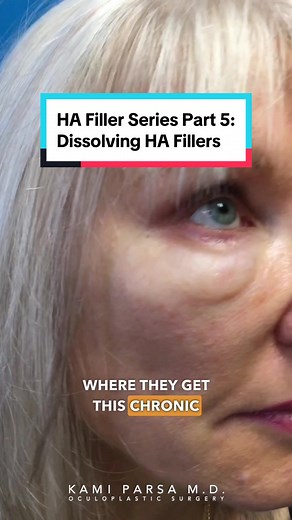 💉HA Filler Series Part 5: Does Dissolving HA Fillers Destroy My Natural Tissue? In today’s video, we discuss the common question of whether dissolving hyaluronic acid fillers in the face destroy your natural tissue. We explain that hyaluronic acid is a natural substance found in our bodies, and the fillers used are a modified cross-linked version that lasts longer. Issues arise when too much filler is injected over time, leading to problems like chronic swelling. Shout out to Dr. Subbio for the