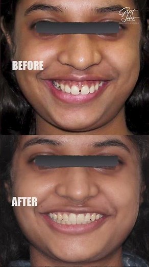 Dental Braces | Invisalign | Before and After - #invisalignbeforeandafter #braces #bracesoff