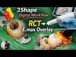 3Shape Digital Workflow: RCT to E.max Overlay Step-by-Step