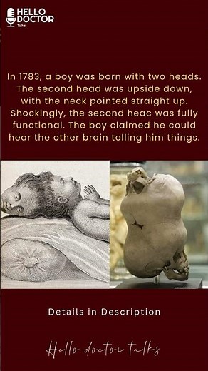 The Two-Headed Boy of Bengal: Born in 1783 with a fully formed second head.