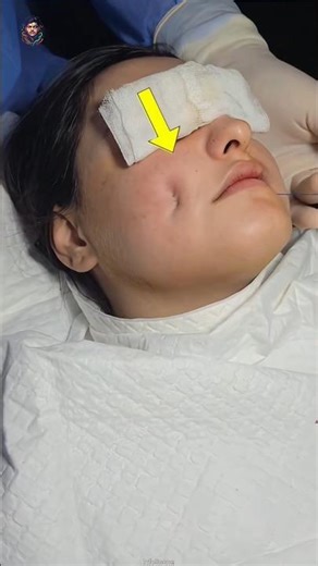 Amazing Dimple Creation Treatment 🫢 #facts #shorts