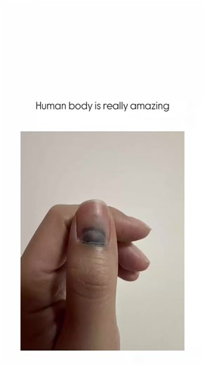 Warm Vibes ✨ on Instagram: "The post features a time-lapse video of a severely bruised fingernail detaching and fully regrowing over months, illustrating the body's natural regeneration process after trauma like a subungual hematoma.Fingernails regenerate from the nail matrix at about 3-4 mm per month, with full recovery typically taking4-6 months, as supported by dermatological studies in the Journal of Investigative Dermatology.Replies highlight practical tips like relieving pressure by punctu