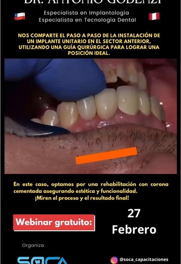 Instalación de Implante Dental: Proceso y Resultados