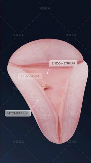 What is a uterine fibroid and how can it affect fertility? Explore gynecology in 3D