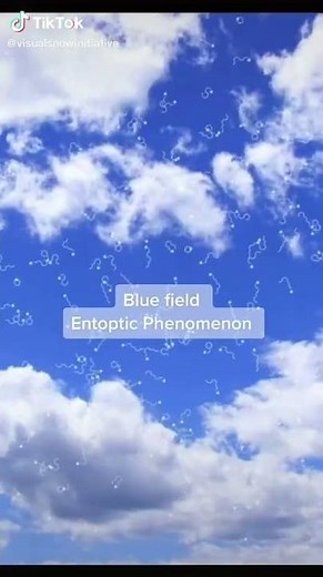 Visual Snow Syndrome be like...