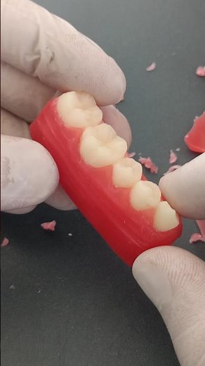temporary teeth with Wax gum #smiledesigndental #dentalfilling #dentist #dentalartistry #dental