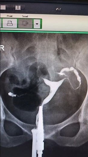Hsg Hysterosalpingography procedure