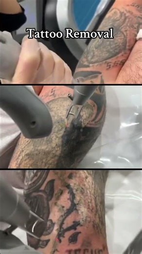 Tattoo Removal NOW Available at Our SYDNEY Clinic?