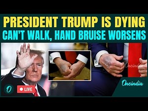 LIVE: Trump Dying Slowly? Hand Bruise and Stair Fumble Raise Concerns About 79 Year Trump's Health