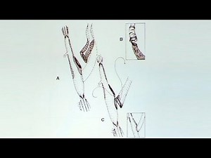 Eversion Endarterectomy: Equivalent to Standard CEA?