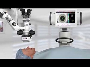 ORA System for Cateract surgery