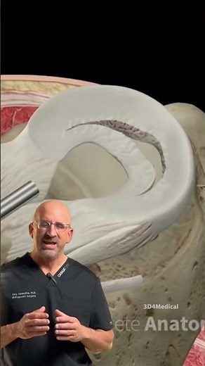 Knee Locked Up? Bucket Handle Meniscus Tear Explained #surgery