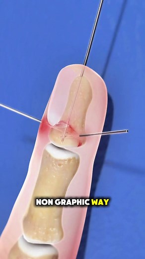 How a Finger Fracture Is Treated (3D Animation) A Finger Fracture is treated based on severity. Doctors may realign the bone and use splints or perform surgery to fix the Finger Bones with pins or screws. This helps restore alignment, healing, and normal function. #fingerfracture #bones #orthopedics #medicalanimation #3danimation