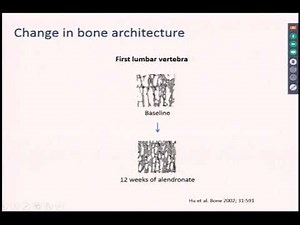 Osteoporosis 101: Basic Concepts in Osteoporosis Diagnosis & Biphosphonates 4/10/19