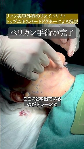 【若返りシリーズ】フェイスリフト＋ペリカン手術の術前解説②