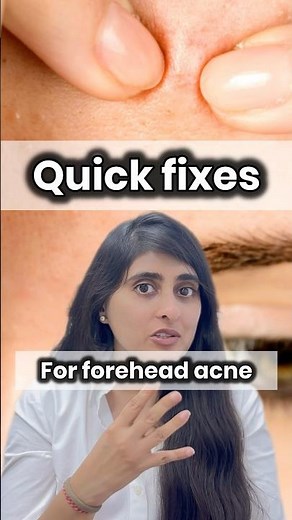 acne on forehead | forehead acne treatment | quick tips for forehead acne