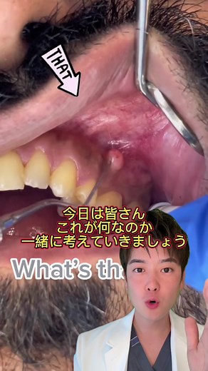 はじめのうちは小さいできもののようですが、時間が経つにつれて徐々に大きくなり、ある一定の大きさになったら止まるか、少しずつ大きくなるかのどちらかで、自然に小さくなることはありません。炎症が起きているわけではないので、痛みがないというのが特徴です😊 明日のお昼にコメント欄に答えを載せます☺️🙏#歯科医師 #おすすめ #口腔外科