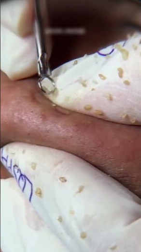 Cystic Acne Removal №7849