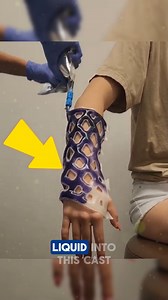 Incredible Replacement for the Traditional Cast This incredible replacement for the traditional cast is changing how we heal. Instead of bulky layers, doctors apply a flexible net and inject a liquid that quickly hardens into a strong, waterproof cast. It’s lightweight, breathable, and perfect for active recovery. Credits:@cast21official /YT & IG #SmartHealing #MedicalInnovation #NextGenCare #medical #plaster | OnyN News