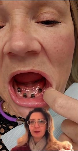 طقم اسنان ثابت دائم All on 4 denture