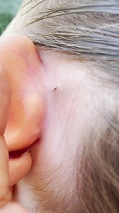 42K views · 88 reactions | A hotspot for head lice is behind the ears just because they have double the warmth. 9 times out of 10 I find lice behind my clients ears. Click link in bio for lice kits #lice #momlife #hair #school #piojos #explore | Stacey The Louse Lady | Facebook