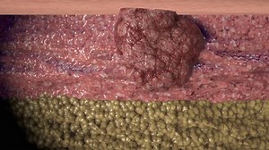 Cancer cell growth animation. Tumor growing under skin tissue.