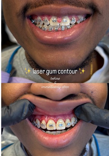 Transforming Gummy Smiles with Cosmetic Braces