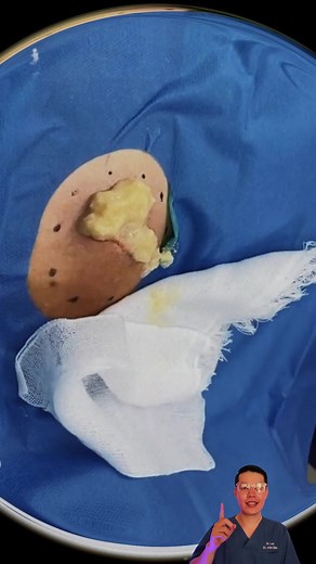 Squeeze super big cyst on back #pimple #cyst #blackhead #pimplepop #acne #acnetreatment #satisfying #relax #foryou