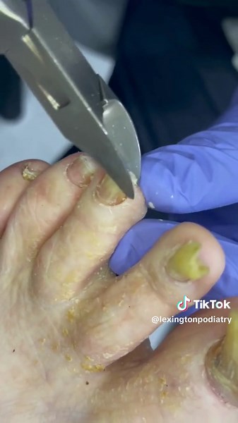 Professional Toenail Trimming Services at Lexington Podiatry
